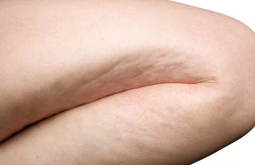 Как выглядит апельсиновая корка на коже The fruit skin