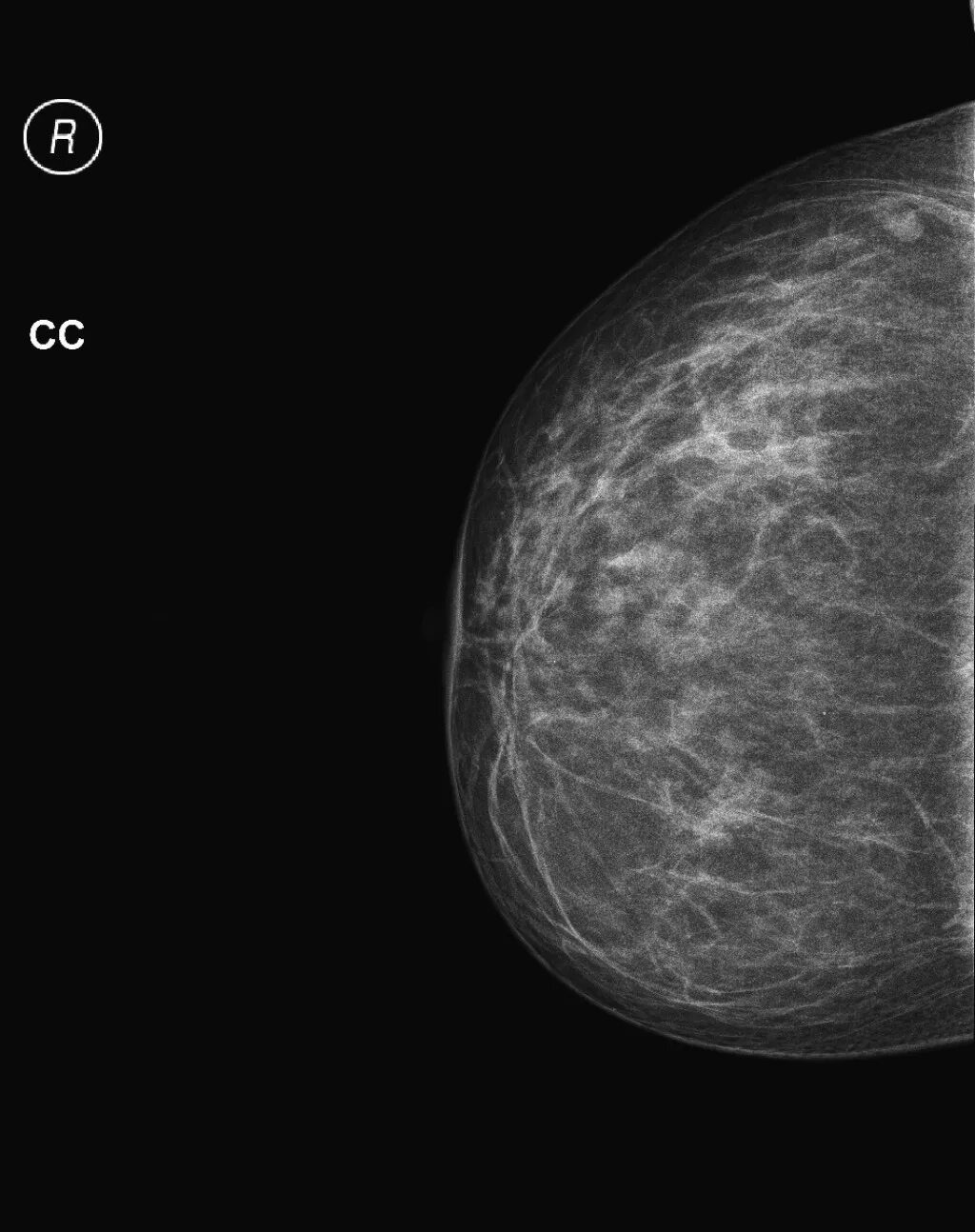 Маммография 4аксделабт. Билатеральная маммография. Маммография снимок в норме. Лимфоузел молочной железы маммография