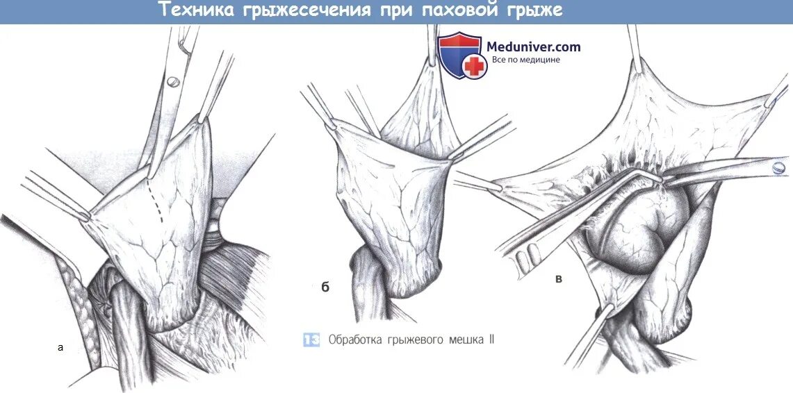 Послеоперационный швы паховая грыжа. Этапы операции грыжа паховой грыжи. Протокол операции грыжесечение паховой грыжи. Грыжесечение ущемленной грыжи.