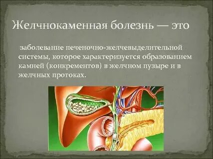 Желчекаменная болезнь отзывы