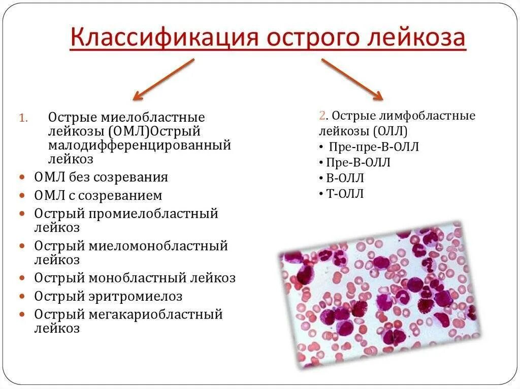 Лейкоз характеризуется. Острый лимфобластный лейкоз миелограмма. Острый лимфобластный лейкоз т3 кортикальный. Лимфобластный лейкоз в2 клеточный. Острый миелобластный лейкоз лейкоцитарная формула.