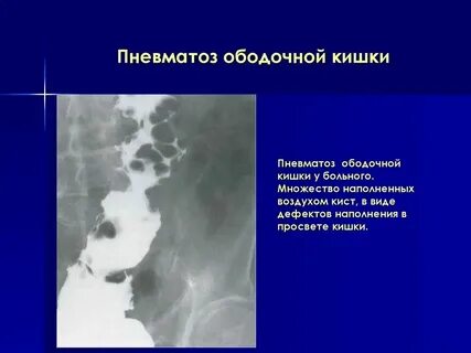 Что такое выраженный пневматоз