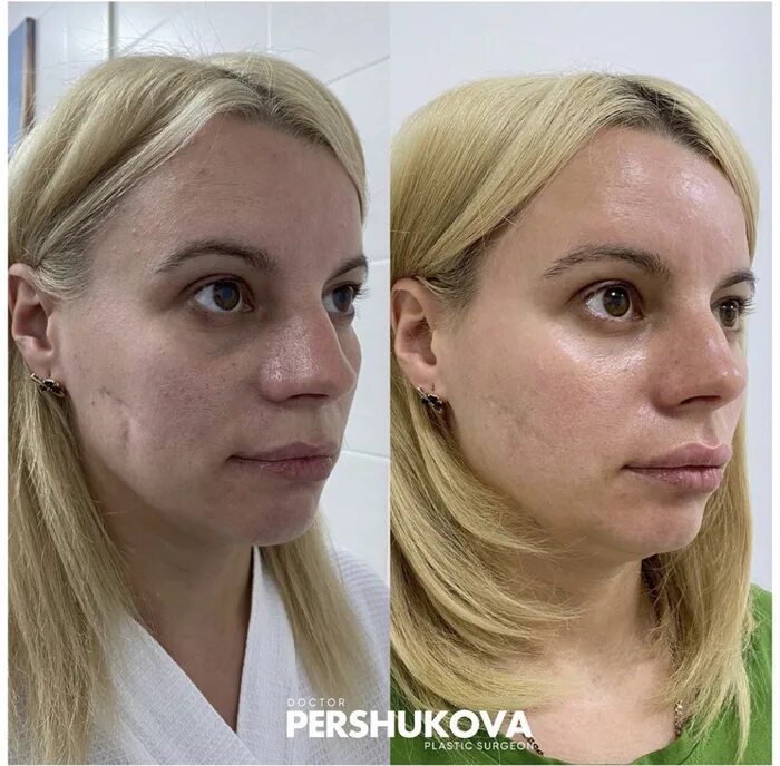 Липофилинг эффект. Липофилинг под глазами реабилитация. липофилинг при асимметрии лица. липофилинг нижних век. липофилинг скул реабилитация.