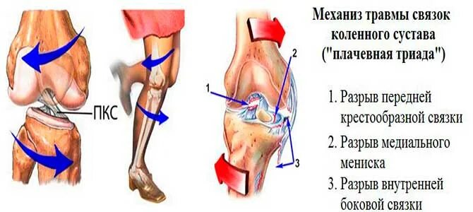 Воспаление коленных связок лечение. Перерастяжение связок коленного сустава. Растяжение сухожилия подколенного сустава. Подколенная связка коленного сустава. Симптомы повреждения сухожилия коленного сустава.