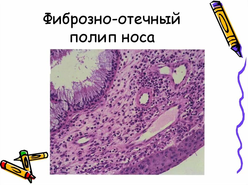 Гистология нос. Фиброзный полип носа гистология. микропрепарат «фиброзно-отечный полип носа». полип это патологическая анатомия. фиброзно отечный полип микропрепарат.