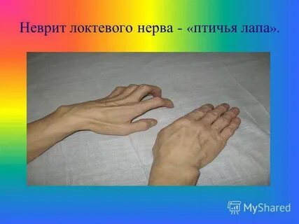 Нейропатия локтевого нерва
