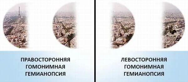 Гомолатеральная гемианопсия. Контралатеральная гомонимная гемианопсия. Гомонимная гемианопсия поражение. Правосторонняя гомонимная гемианопсия. Битемпоральная гемианопсия причины.