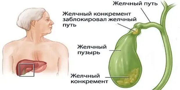 Полипы в желчном пузыре симптомы и лечение. Желудочный пузырь функции. желчный пузырь функции в организме. застой желчи в желчном пузыре. функцияжелочного пузыря в организме человека.