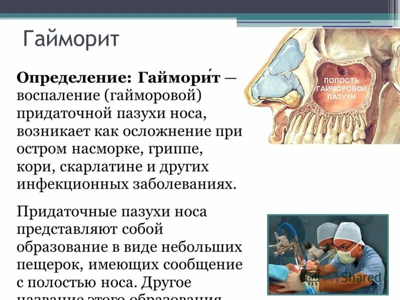 Симптомы гайморита у взрослых без температуры признаки