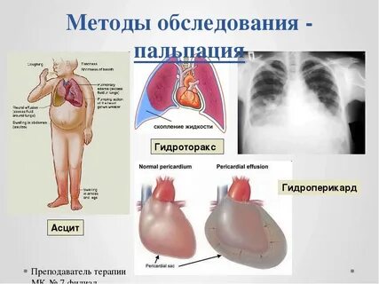 Гидроперикард причины