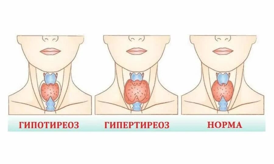 Изменение щитовидной железы у ребенка. Гипотиреоз и гипертиреоз щитовидной железы. Патология щитовидной железы. Гипотиреоз. Щитовидная железа симптомы заболевания у женщин гипотиреоз. Тиреотоксикоз щитовидной железы.