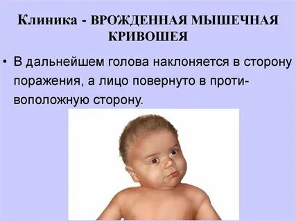 Признаки кривошеи у новорожденного