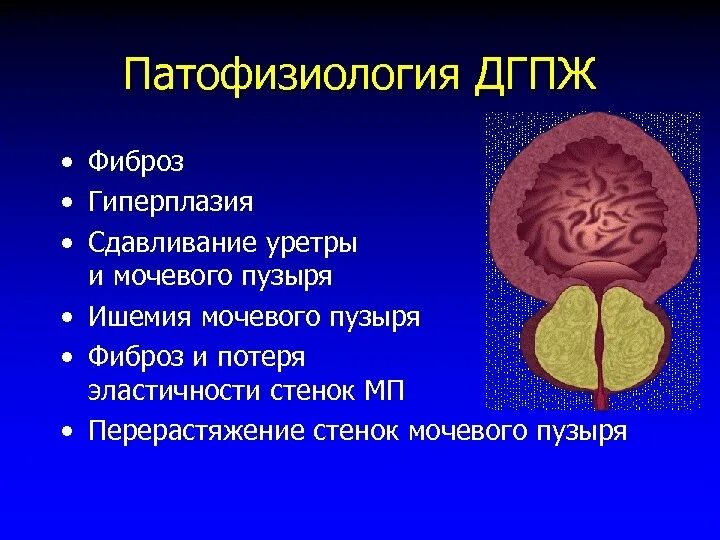 Гиперплазия предстательной железы. Гиперплазия мочевого пузыря. Гипоплазия престатильной железы. Гиперплазия предстательной железы 1