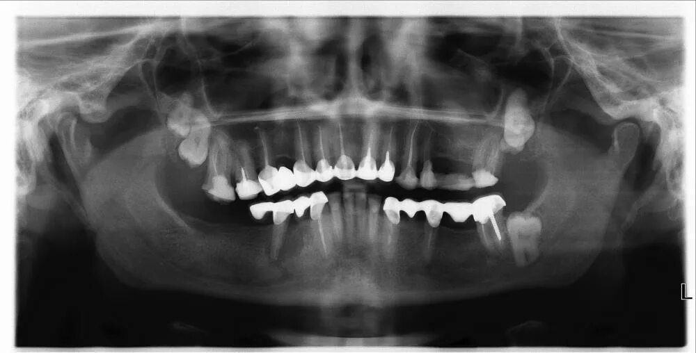Ретинированный дистопированный зуб мудрости. Зубы девятки. Зубы девятки. Сверхкомплектные зубы оптг. Сверхкомплектные зубы рентген.