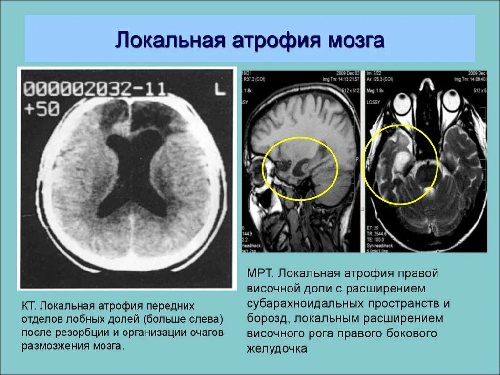 Атрофия головного мозга продолжительность. Локальная корковая атрофия. Локальное расширение субарахноидального пространства. Атрофические изменения головного мозга кт. Субарахноидальные пространства расширены на кт.