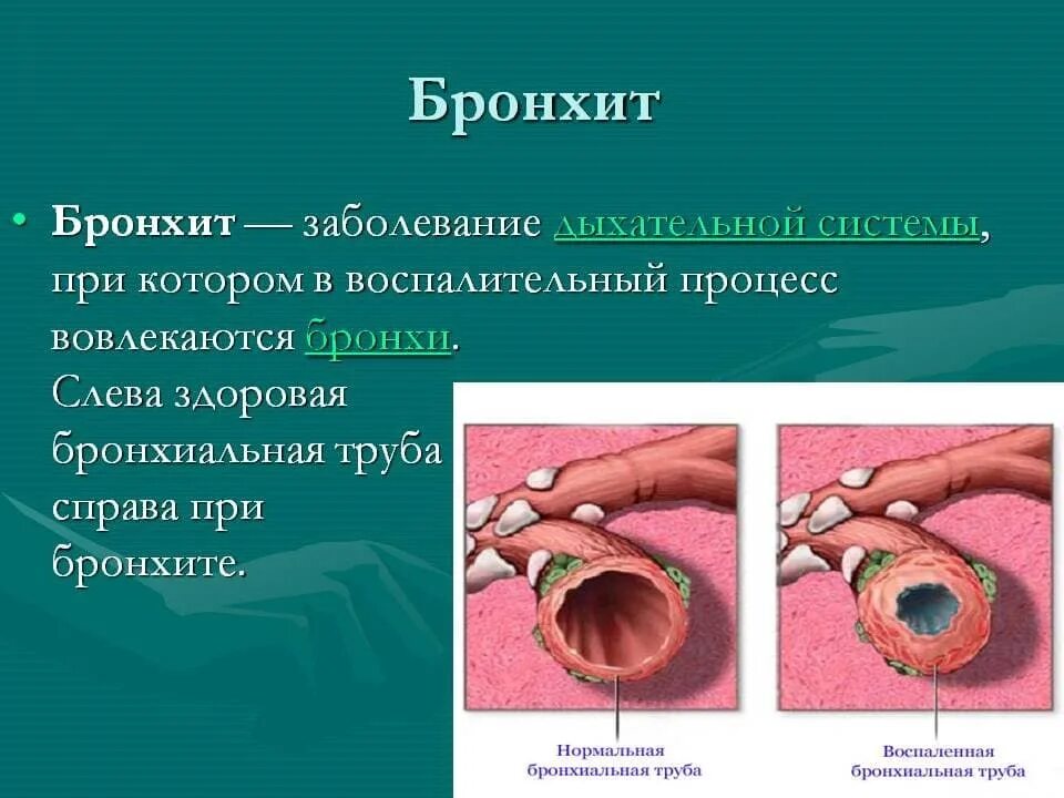 Почему при бронхите