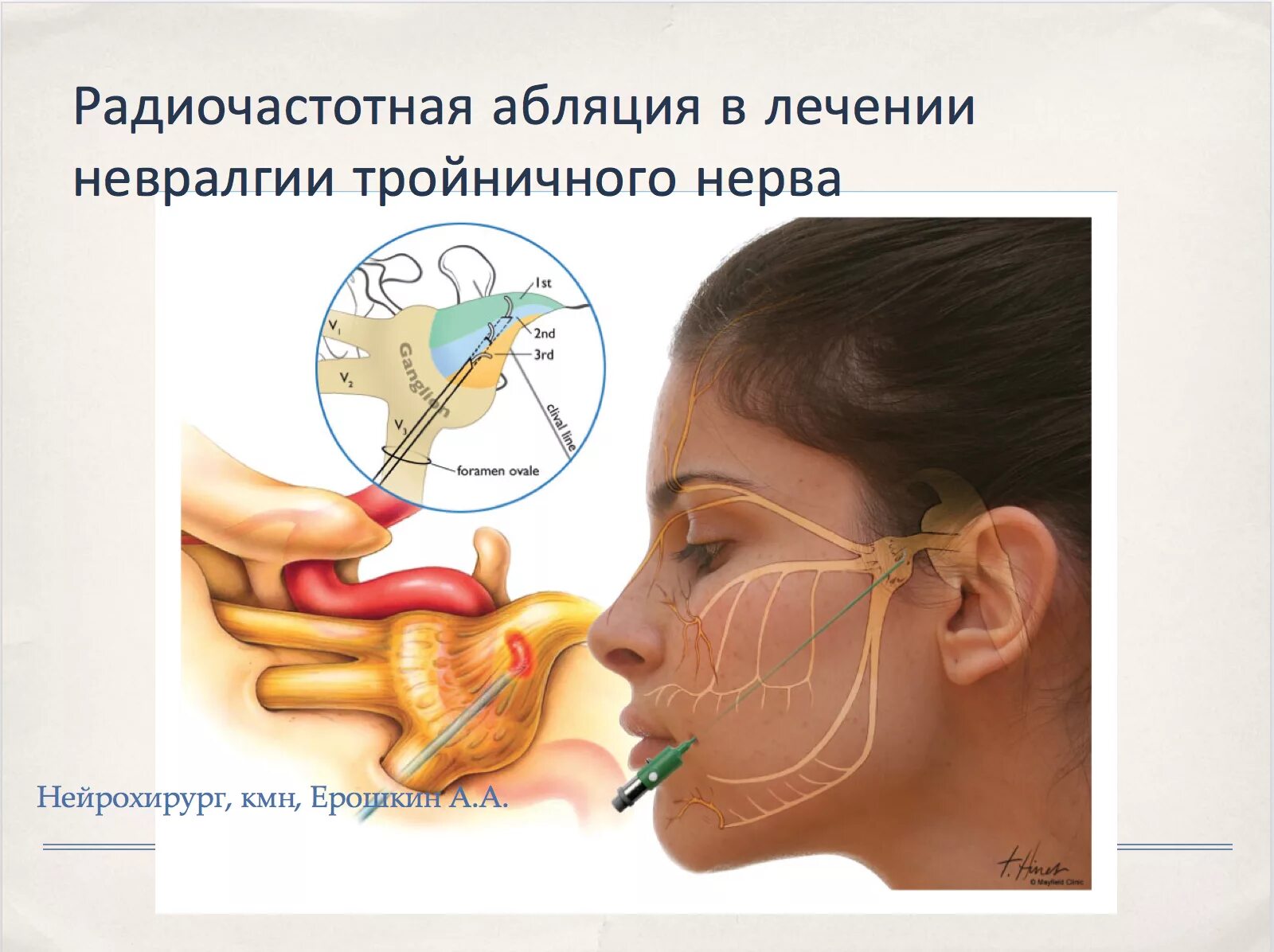 Блокада тройничного. Невралгия тройничного нерва. Радиочастотная деструкция тройничного нерва. Тригеминальная невралгия тройничного нерва. Чрескожная ризотомия тройничного нерва.