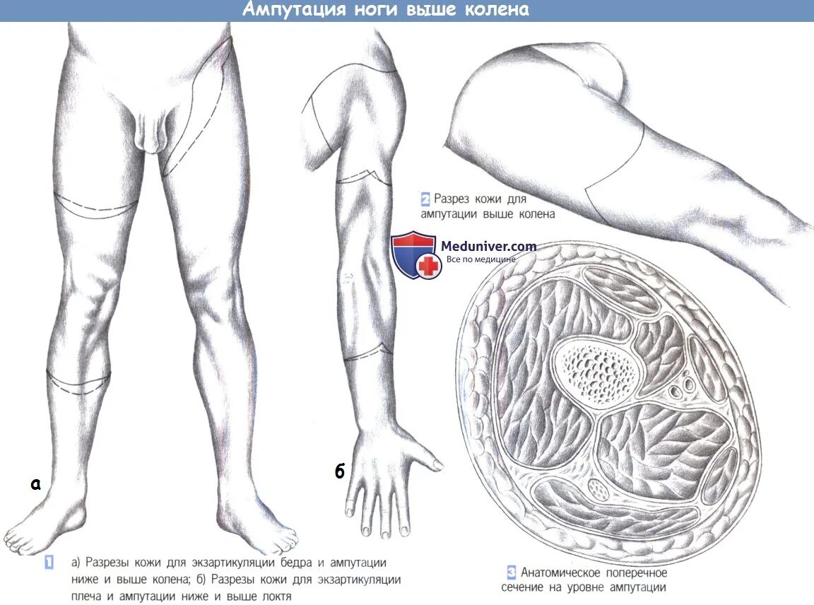 Ноги выше колена. Разрез при ампутации бедра. Ампутирование ног выше колена.