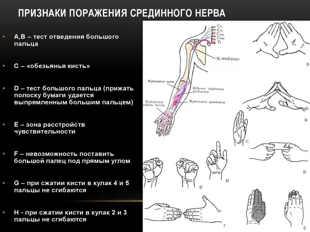 Клинический признак повреждения лучевого нерва. Симптом мельницы при поражении срединного нерва. Симптомы поражения срединного нерва неврология. Синдромы повреждение нервов верхней конечности.