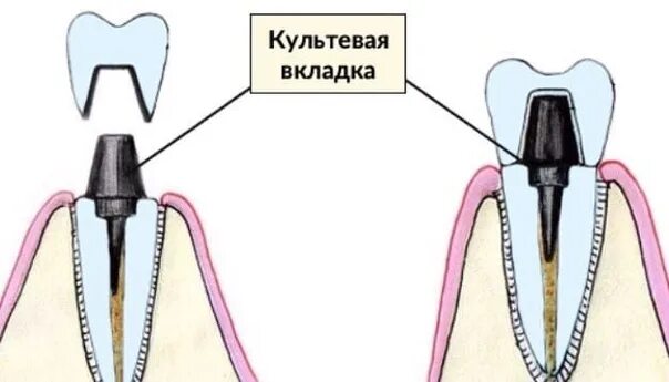 Как делают зубы на штифтах
