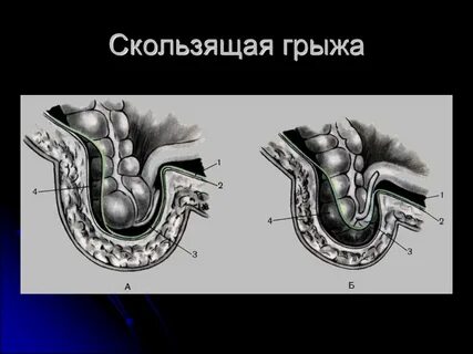 Стенки пупочной грыжи