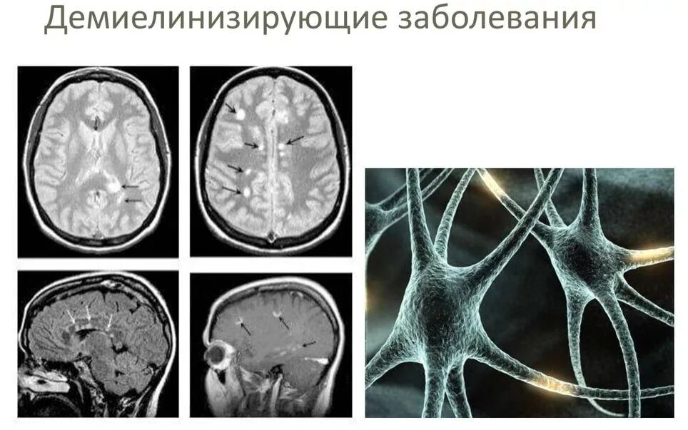 Признаки демиелинизирующего поражения. Очаги глиоза в головном мозге мрт. Очаги глиоза на мрт. Очаги демиелинизации головного мозга на мрт. Демиелинизирующие заболевания головного мозга на мрт.