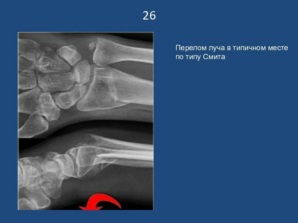 Перелом Смита лучевой кости. Перелом лучевой кости в типичном месте рентген. Перелом Коллиса рентген. Перелом луча в типичном месте рентгенограммы. Не заметил перелом