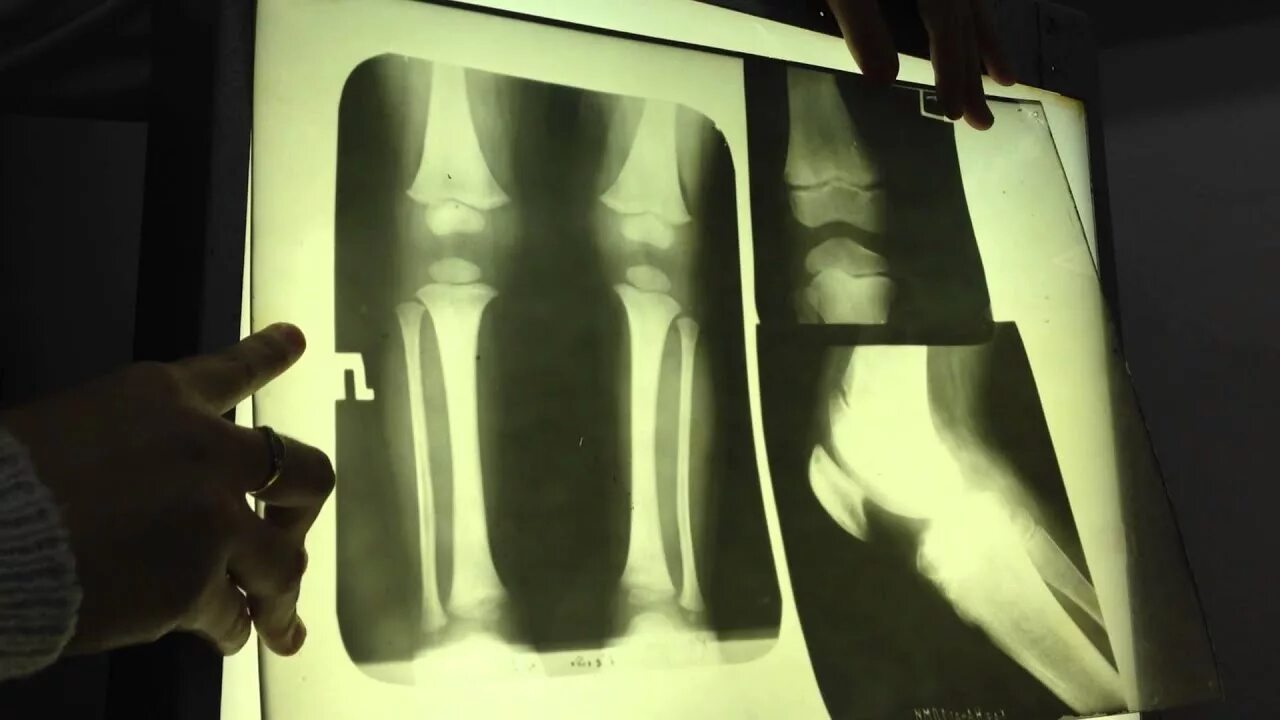 Рентген можно сделать. Рентген 2 коленных суставов. Рентген снимки коленного сустава. Коленный сустав 12 лет рентген. Рентген колена нормальный сустав.
