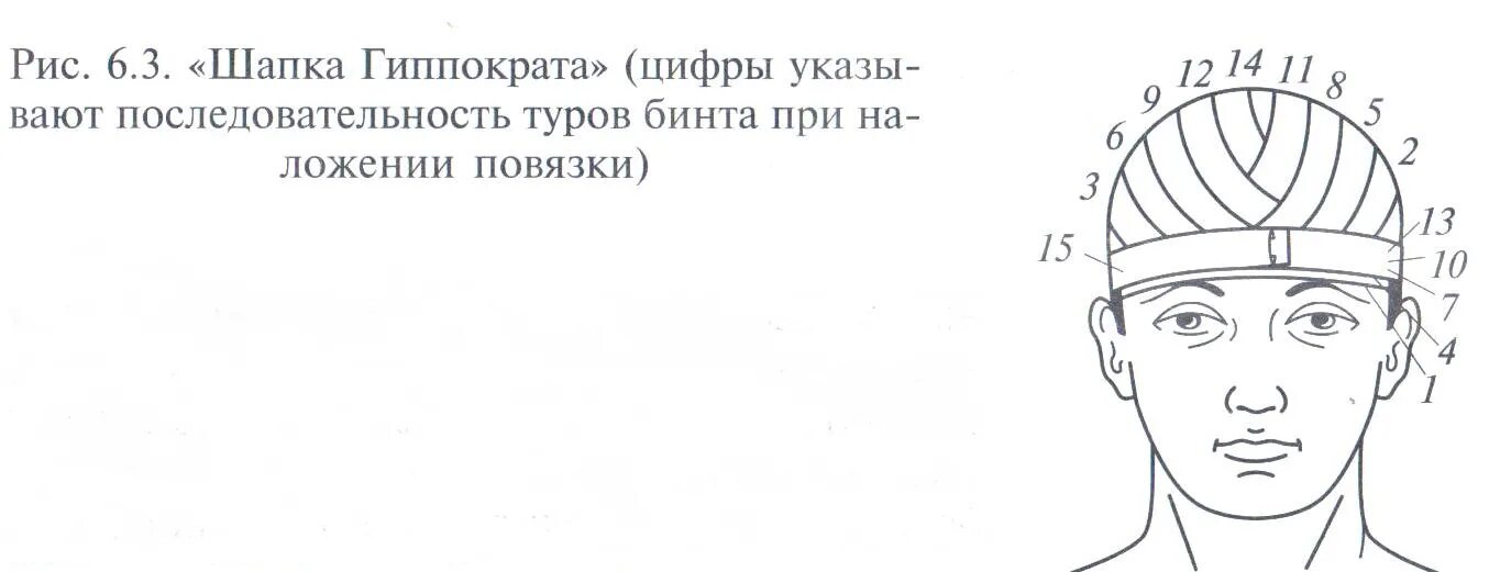 Техника наложения шапочки гиппократа. Схема наложения повязки шапка Гиппократа. Перевязка шапочка Гиппократа. Чепец Гиппократа повязка.