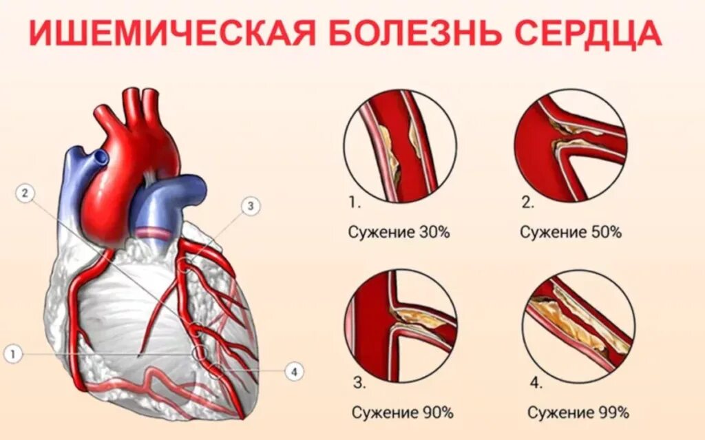 Ишемия причины симптомы. Ишемическая болезнь сердца. Ишемическая болезнь сердца (ИБС). Ишемические поражения сердца. Заболевания коронарных сосудов.