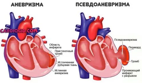 Истинные и ложные аневризмы