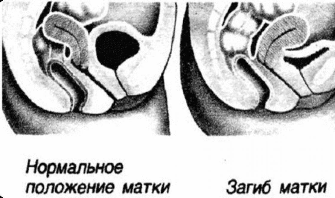 Можно ли забеременеть при загибе матки. Расположение шейки матки кзади. сильный загиб матки. положение матки.