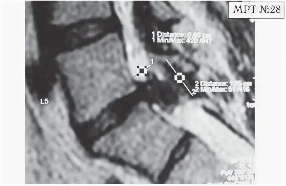 Протрузия l3-l4 l4-l5. Уплотнение задней продольной связки мрт. Протрузии l4 l5. Секвестрированная экструзия l5-s1 диска. Грыжа диска l3-l4.