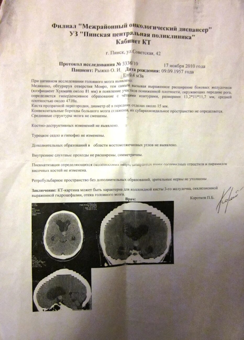 Опухоль головного мозга справка. Справка о опухоли мозга. Заключение врача опухоль мозга. Диагноз опухоль мозга справка. Справка отек мозга