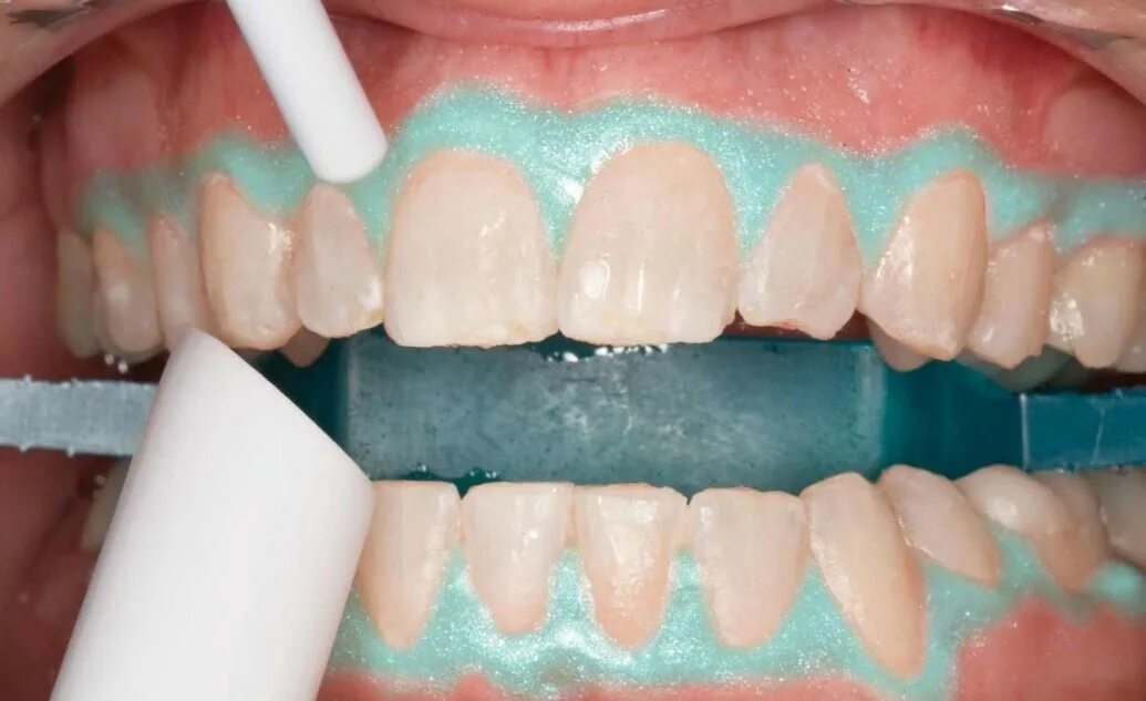 Смола для чистки зубов. Отбеливание Opalescence Boost. Opalescence Boost PF 40%. Отбеливание Опалесценс буст. Аполисцент буст отбеливание зубов.