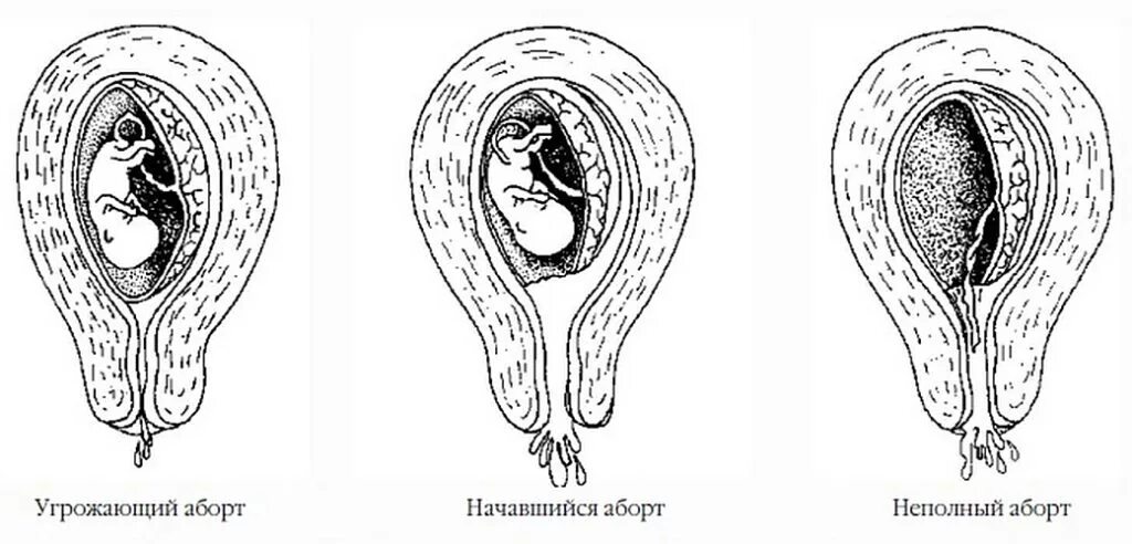 Неполный самопроизвольный выкидыш. Начавшийся самопроизвольный выкидыш. Угрожающий аборт (угрожающий выкидыш). Выкидыш (самопроизвольный аборт). Матка на 1 неделе беременности