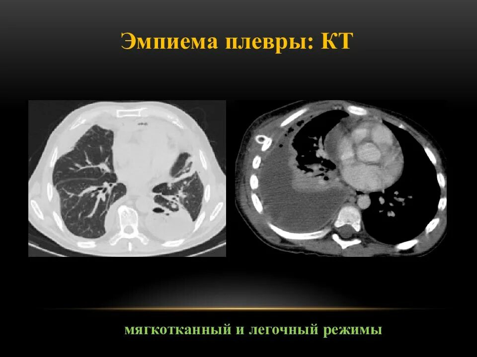 Эмпиема легкого. Осумкованная эмпиема плевры на кт.