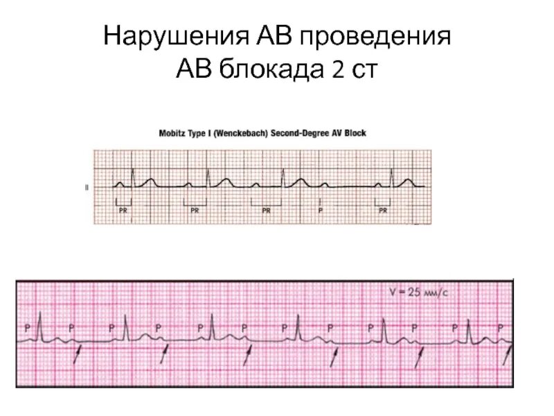 Атриовентрикулярная блокада 2. АВ блокада 2 степени Мобитц 1 на ЭКГ. АВ блокада 2 степени Мобитц 3. Блокада 2ст Мобитц 2. Атриовентрикулярная блокада 2 ст.