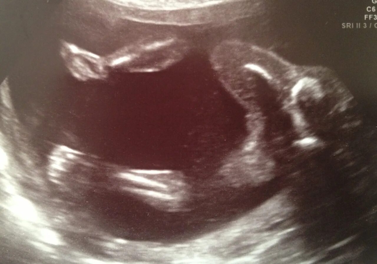 19 Недель беременности фото. 18 19 Недель беременности. Беременность 18-19 недель фото. Малыш на 19 неделе