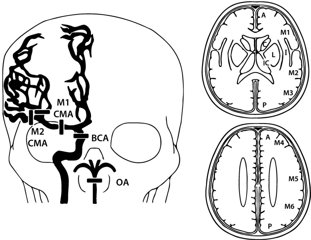 Aspect ишемический инсульт кт. Шкала аспектс для оценки инсульта. Среднемозговая артерия сегменты. М1 сегмент средней мозговой артерии схема. Сегмент а1 пма