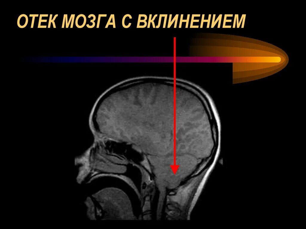 Смерть от отека мозга. Отек набухание головного мозга. Отёк и набухание головного мозга.