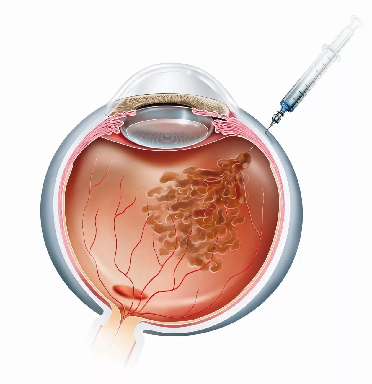 Интравитреальная инъекция. Введение ингибитора ангиогенез. Анти-VEGF препараты. Интравитреальное Введение ингибиторов ангиогенеза. Интравитреальное Введение Луцентиса.