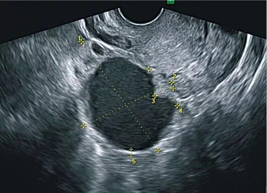 Муцинозная опухоль яичника на УЗИ. Псевдомуцинозная киста. Муцинозная киста яичника на УЗИ. Серозная цистаденома яичника на УЗИ. Можно с кистой в баню