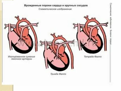 С пороком сердцем родит можно