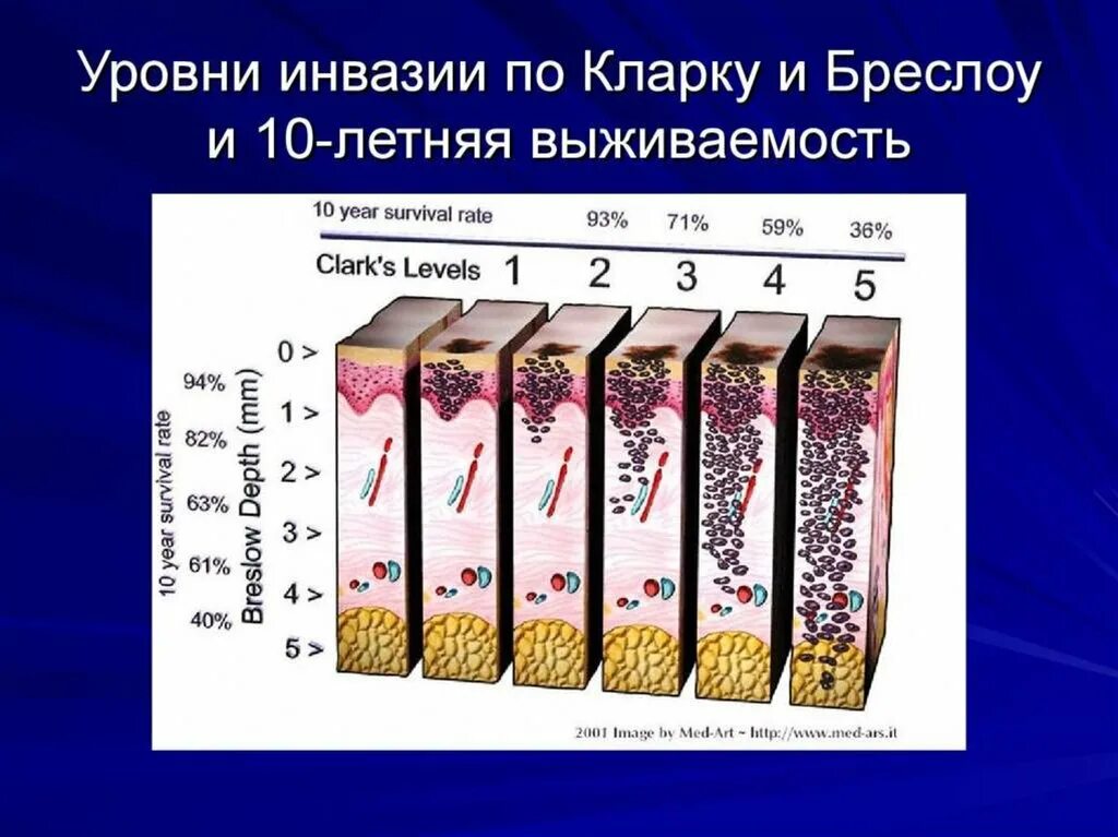 Уровни инвазии по Кларку и Бреслоу. Уровни инвазии меланомы кожи по Кларку. 4 Степень инвазии по Кларку меланома. Меланома уровень инвазии по Кларку 3.