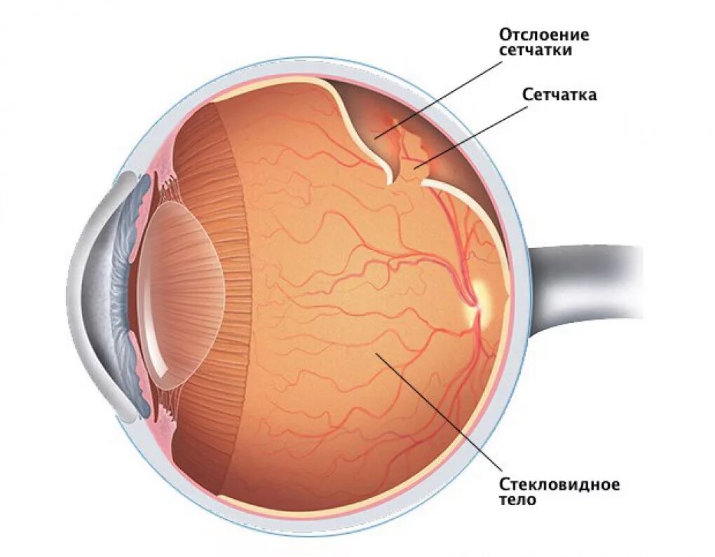 Почему мешает в глазах. Отслойка сетчатки глаза. Отслоение сетчатки на глазу на глазах. Регматогенная отслойка сетчатки. Отслойка сетчатки ретинальный разрыв.
