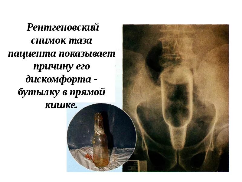 Повредил прямую кишку