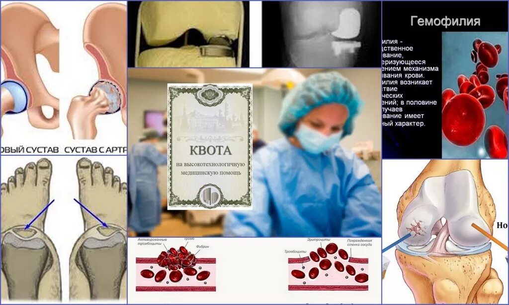 Квота на операцию сустава. Как оформить квоту на операцию. Квота на операцию по тазобедренным суставом. Сайт квоты на операцию