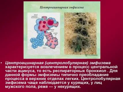 Эмфизема легких что это такое простыми словами