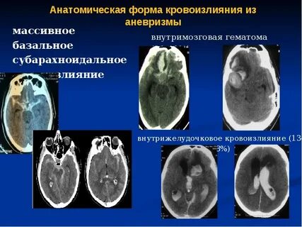 Степени кровоизлияния